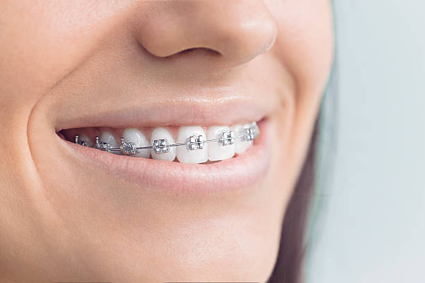 Best Traditional Braces  in Monterey, CA